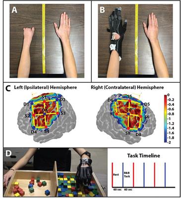 Use-Dependent Prosthesis Training Strengthens Contralateral Hemodynamic Brain Responses in a Young Adult With Upper Limb Reduction Deficiency: A Case Report